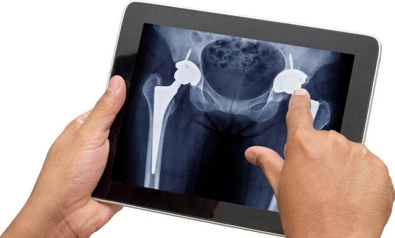 Why are Indians in their 30s increasingly having to get hip replacements?