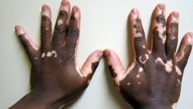 Children with vitiligo face stigma and battle misinformation: this needs to change
