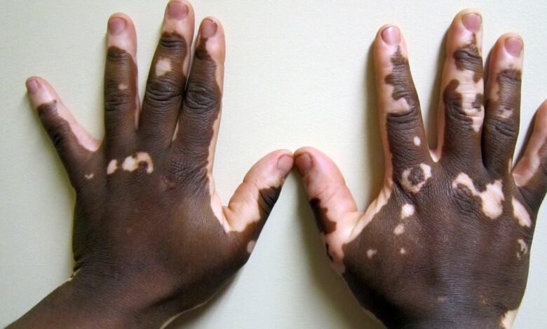 Children with vitiligo face stigma and battle misinformation: this needs to change